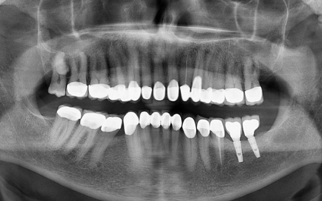 Digitalni zubni rendgen