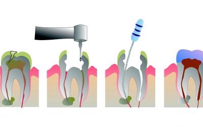 Vađenje živca iz zuba (endodoncija)