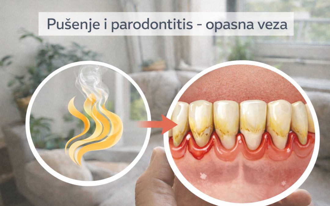 Pušenje i parodontitis: tiha prijetnja zdravlju vaših desni
