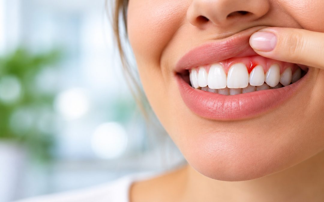 Krvarenje desni: uzroci, gingivitis i parodontitis